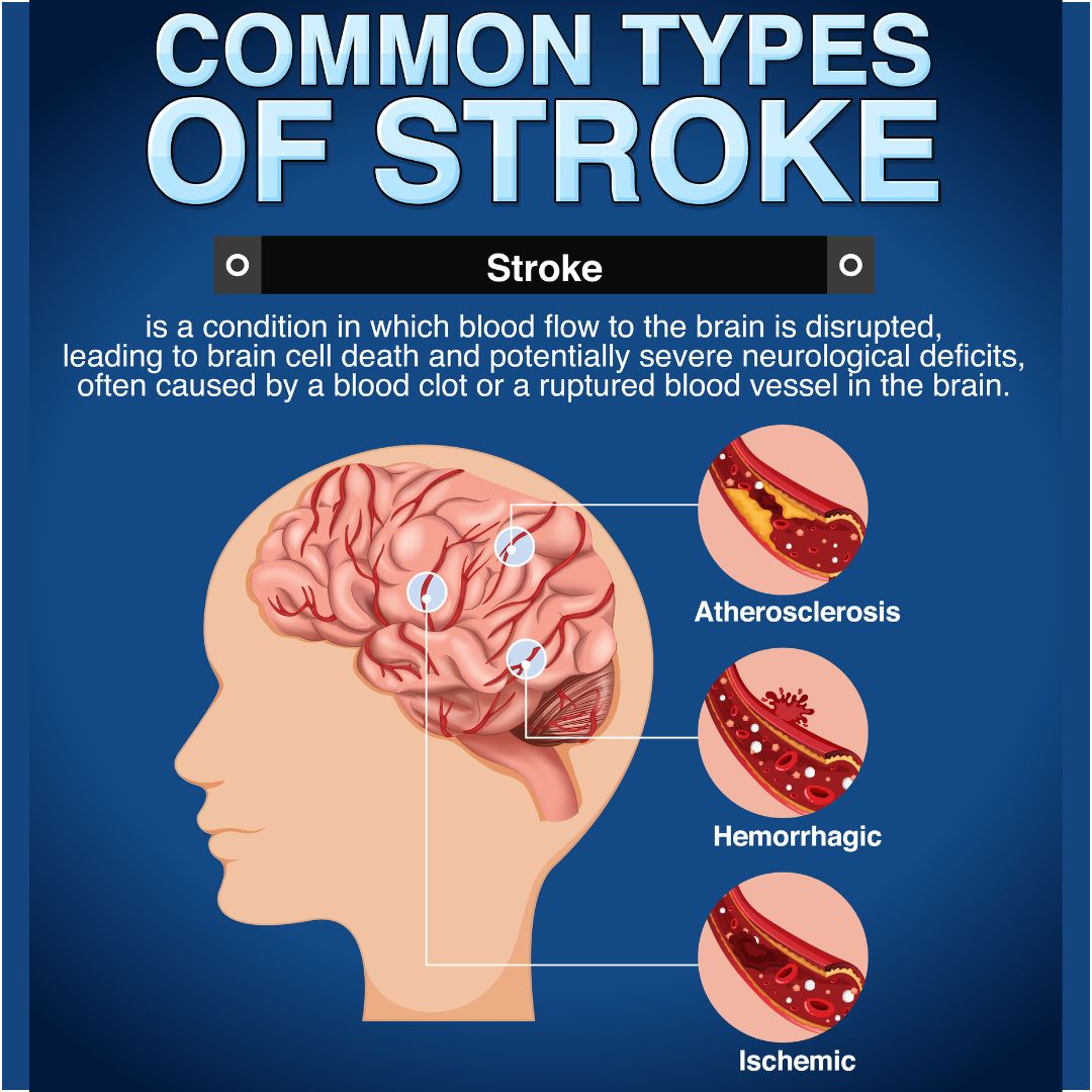 Coomon types of strokes